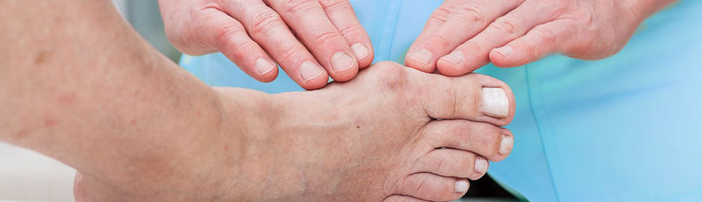 Bunions Today